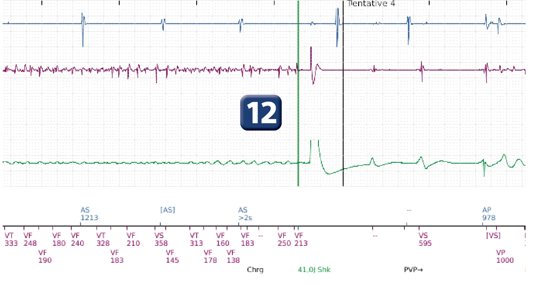 Électrogramme Boston Scientific DAI, segment 11 sur 14 — TV en zone de FV et seuil de défibrillation élevé