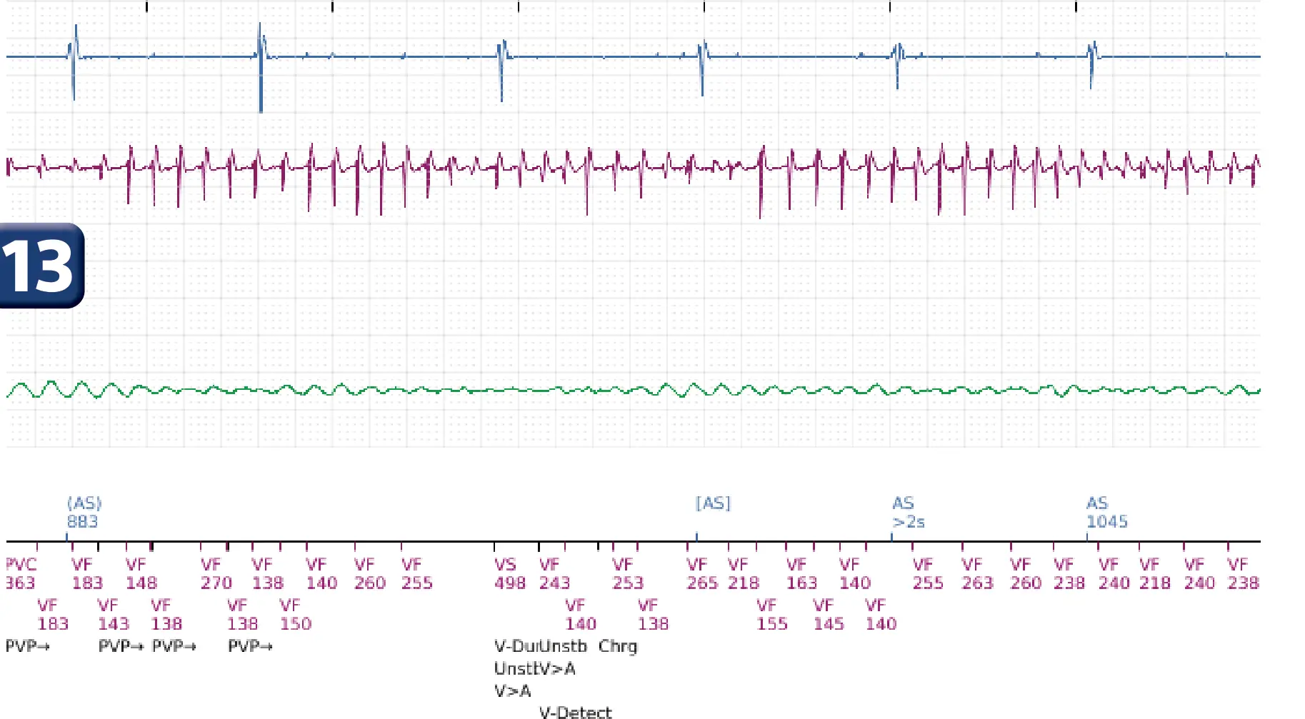 Électrogramme Boston Scientific DAI, segment 12 sur 14 — TV en zone de FV et seuil de défibrillation élevé