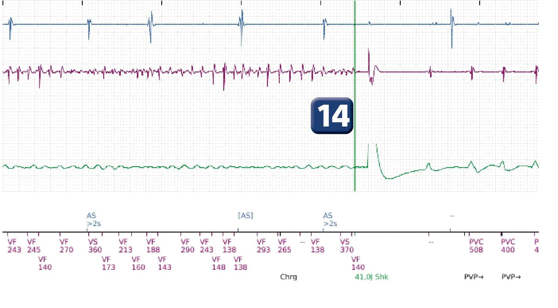 Électrogramme Boston Scientific DAI, segment 13 sur 14 — TV en zone de FV et seuil de défibrillation élevé