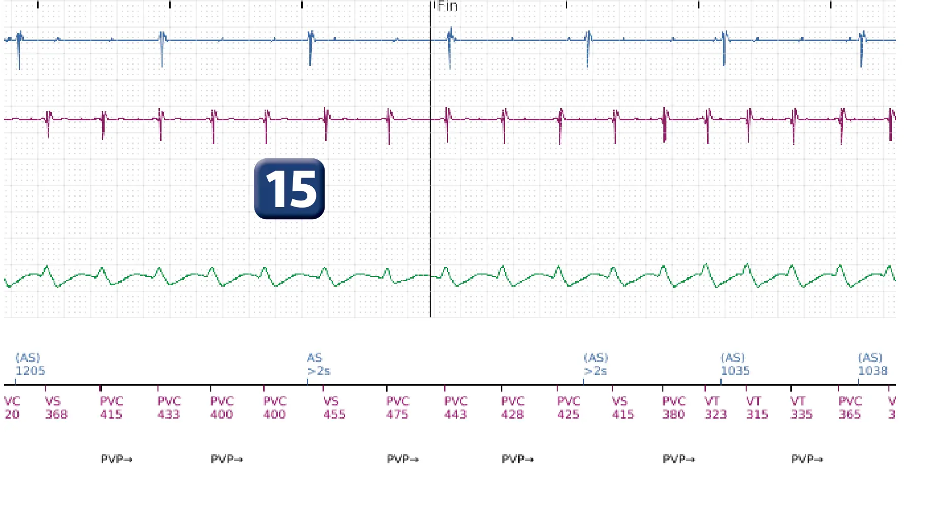 Électrogramme Boston Scientific DAI, segment 14 sur 14 — TV en zone de FV et seuil de défibrillation élevé