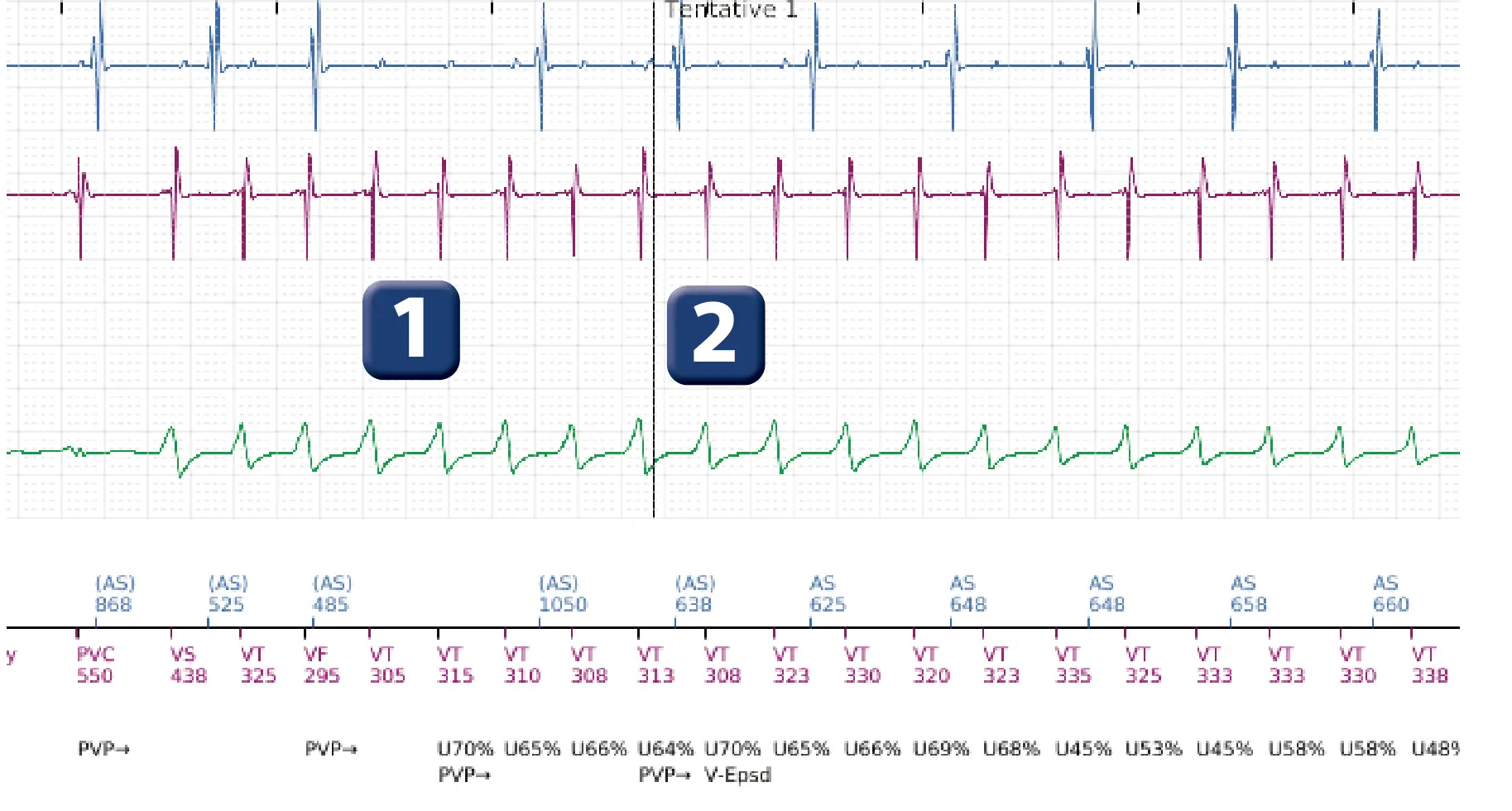 Électrogramme Boston Scientific DAI, segment 2 sur 14 — TV en zone de FV et seuil de défibrillation élevé