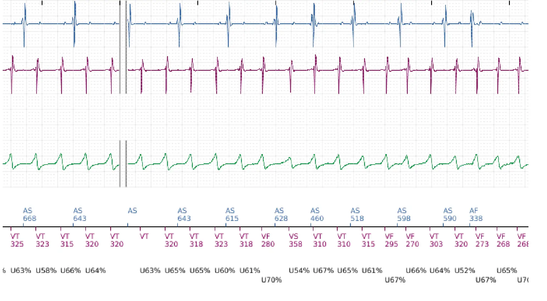 Électrogramme Boston Scientific DAI, segment 3 sur 14 — TV en zone de FV et seuil de défibrillation élevé