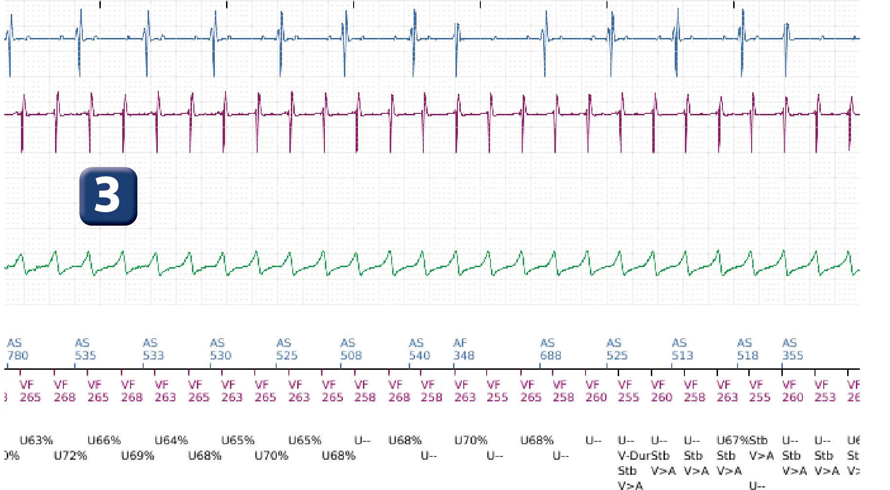 Électrogramme Boston Scientific DAI, segment 4 sur 14 — TV en zone de FV et seuil de défibrillation élevé