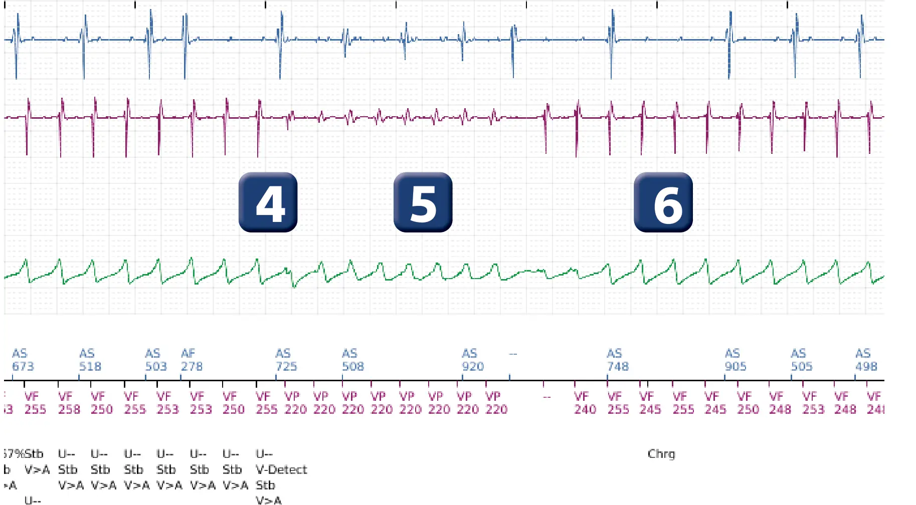 Électrogramme Boston Scientific DAI, segment 5 sur 14 — TV en zone de FV et seuil de défibrillation élevé
