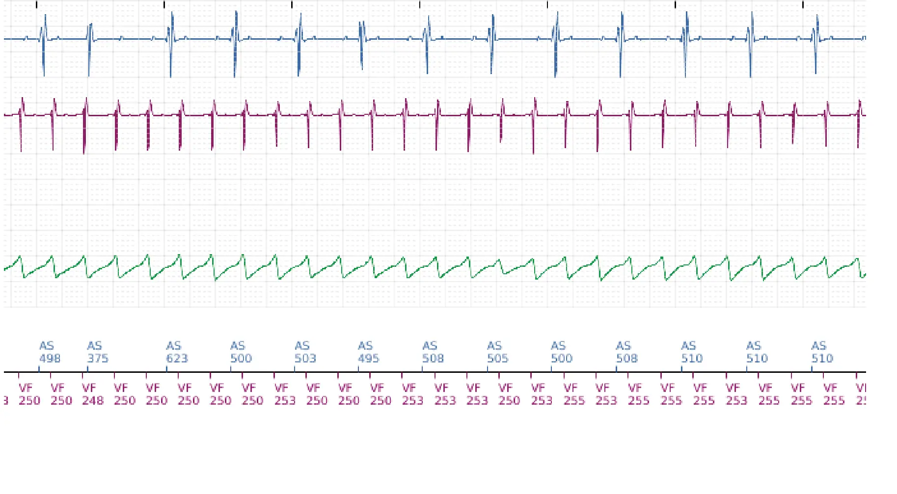 Électrogramme Boston Scientific DAI, segment 6 sur 14 — TV en zone de FV et seuil de défibrillation élevé