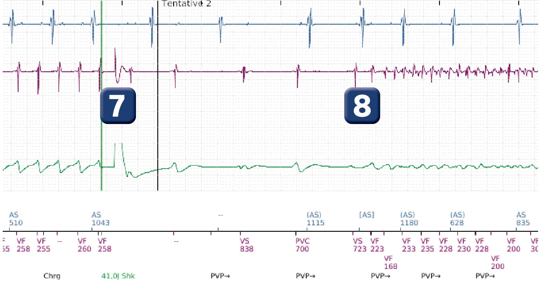 Électrogramme Boston Scientific DAI, segment 7 sur 14 — TV en zone de FV et seuil de défibrillation élevé
