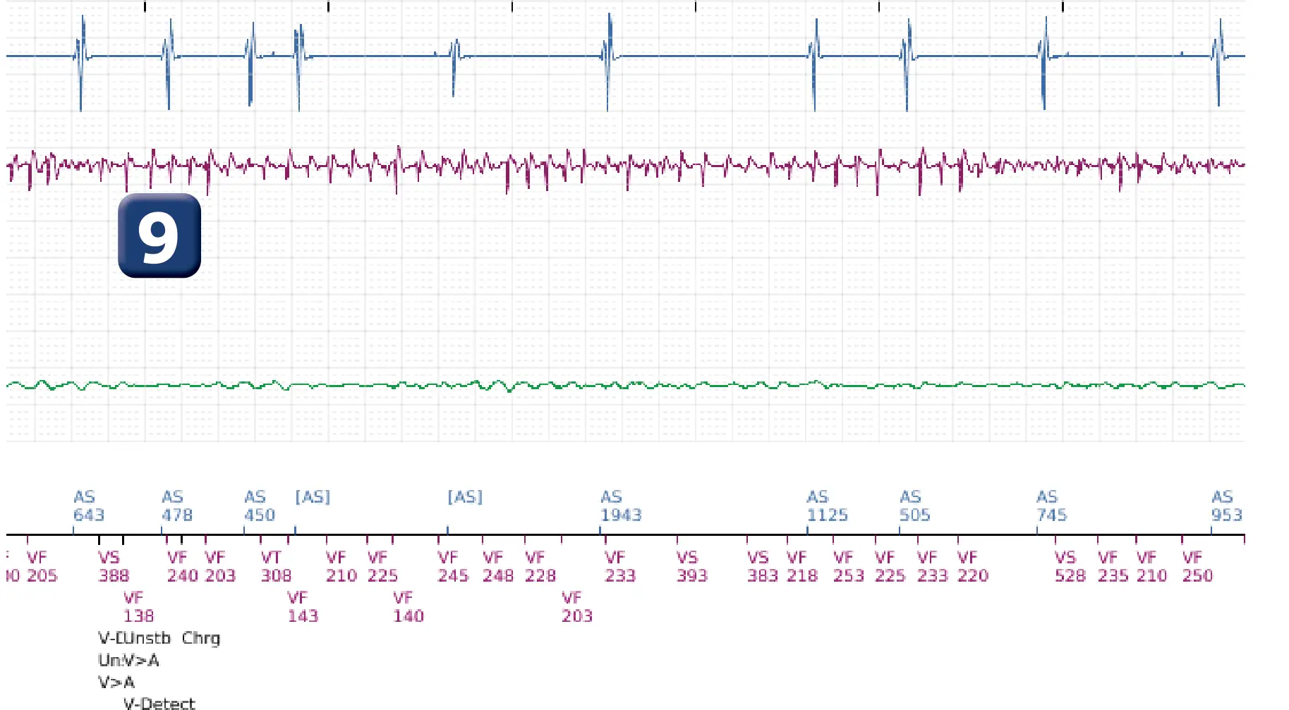 Électrogramme Boston Scientific DAI, segment 8 sur 14 — TV en zone de FV et seuil de défibrillation élevé