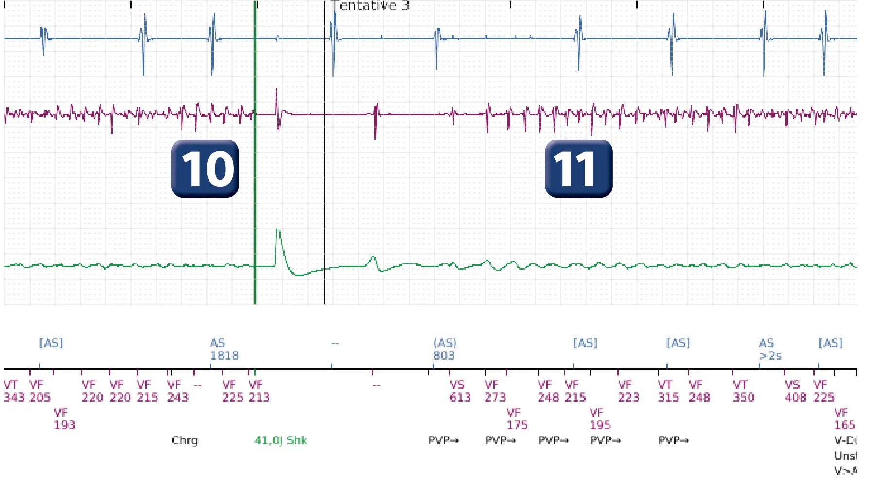 Électrogramme Boston Scientific DAI, segment 9 sur 14 — TV en zone de FV et seuil de défibrillation élevé