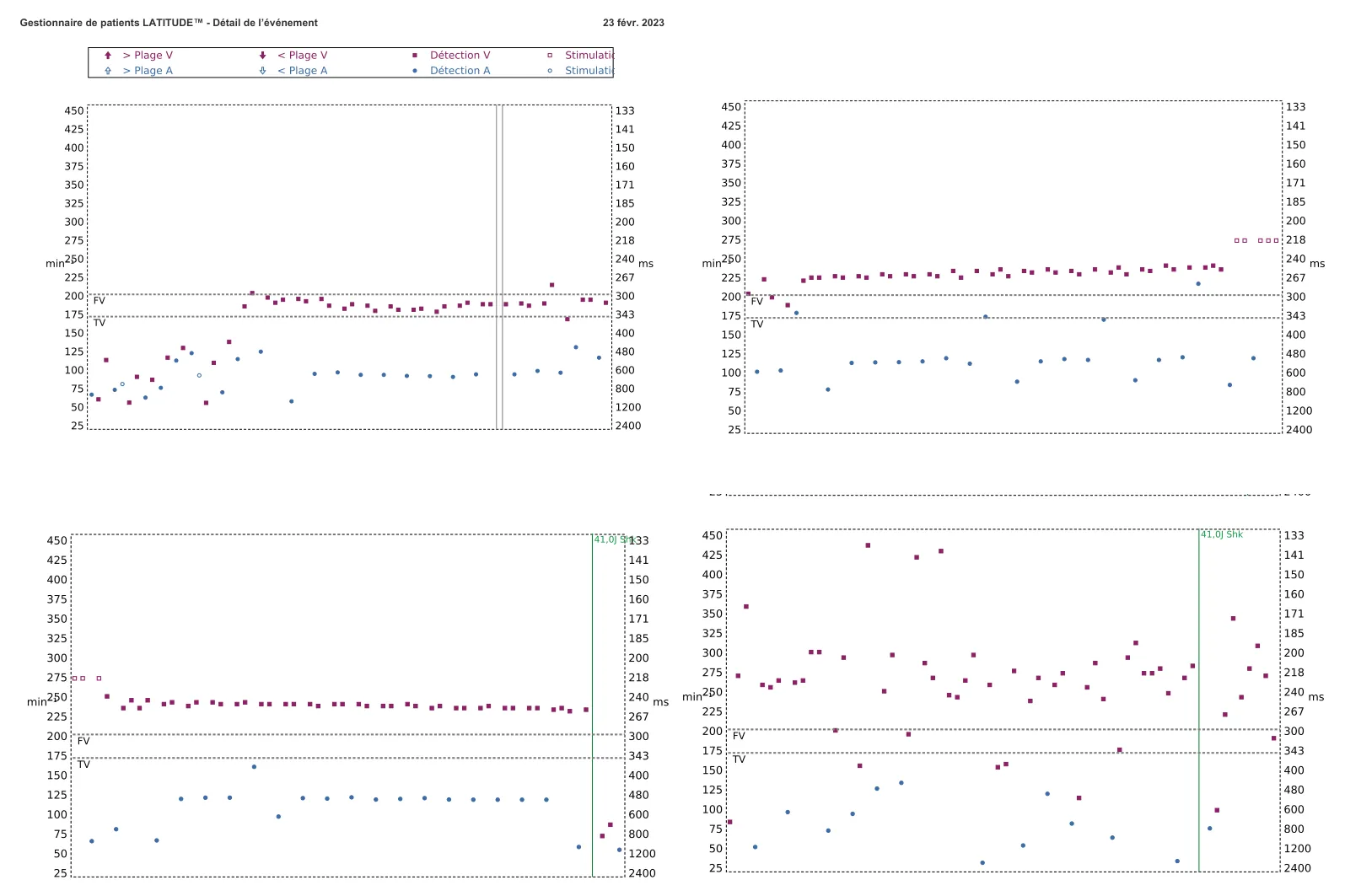 Figure — TV en zone de FV et seuil de défibrillation élevé