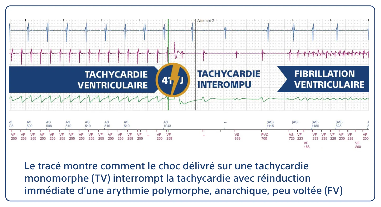 Le tracé montre comment le choc délivré sur une tachycardie monomorphe (TV) interrompt la tachycardie avec réinduction immédiate d’une arythmie polymorphe, anarchique, peu voltée (FV)