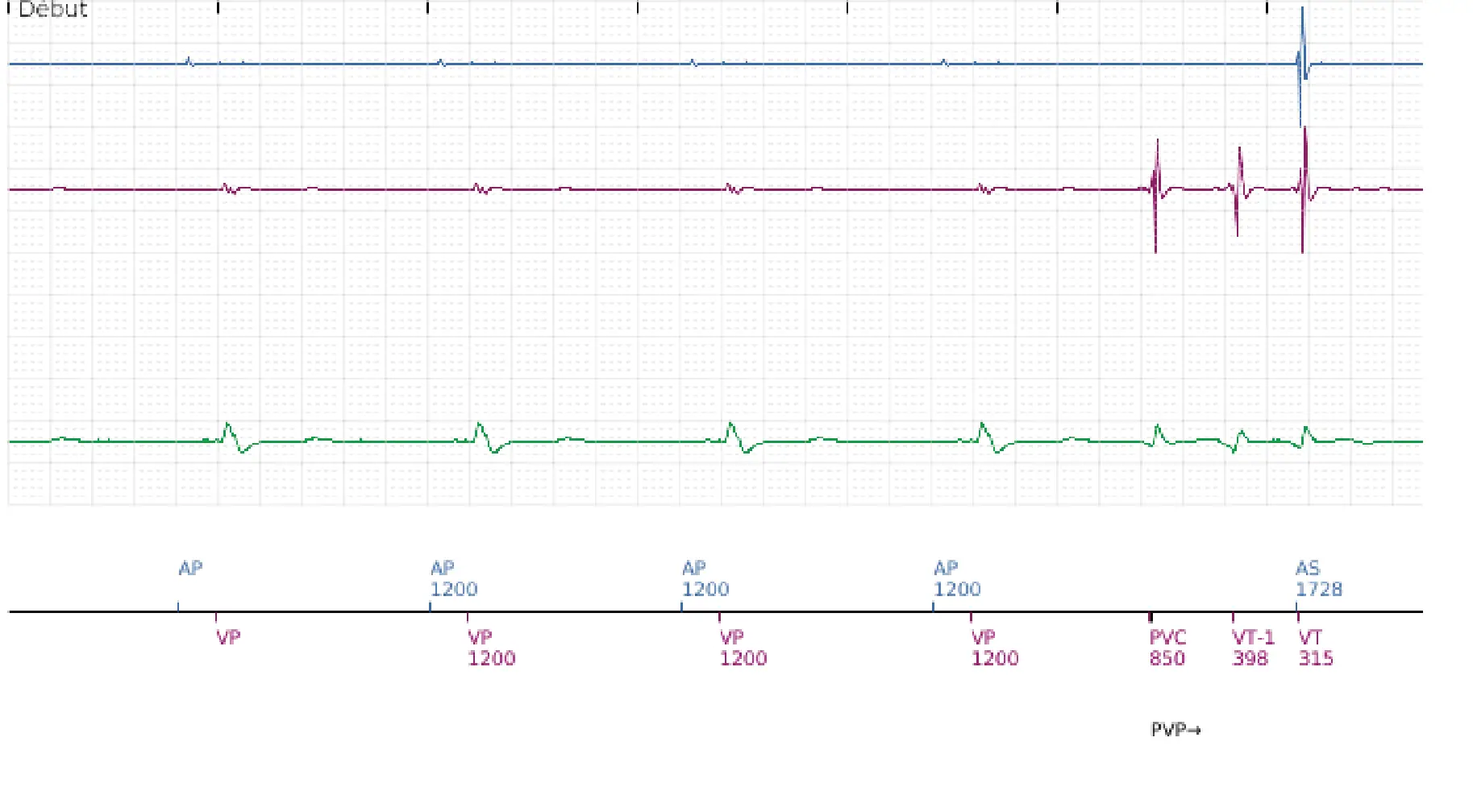 Électrogramme Boston Scientific DAI, segment 1 sur 7 — FV, choc électrique et induction de FA