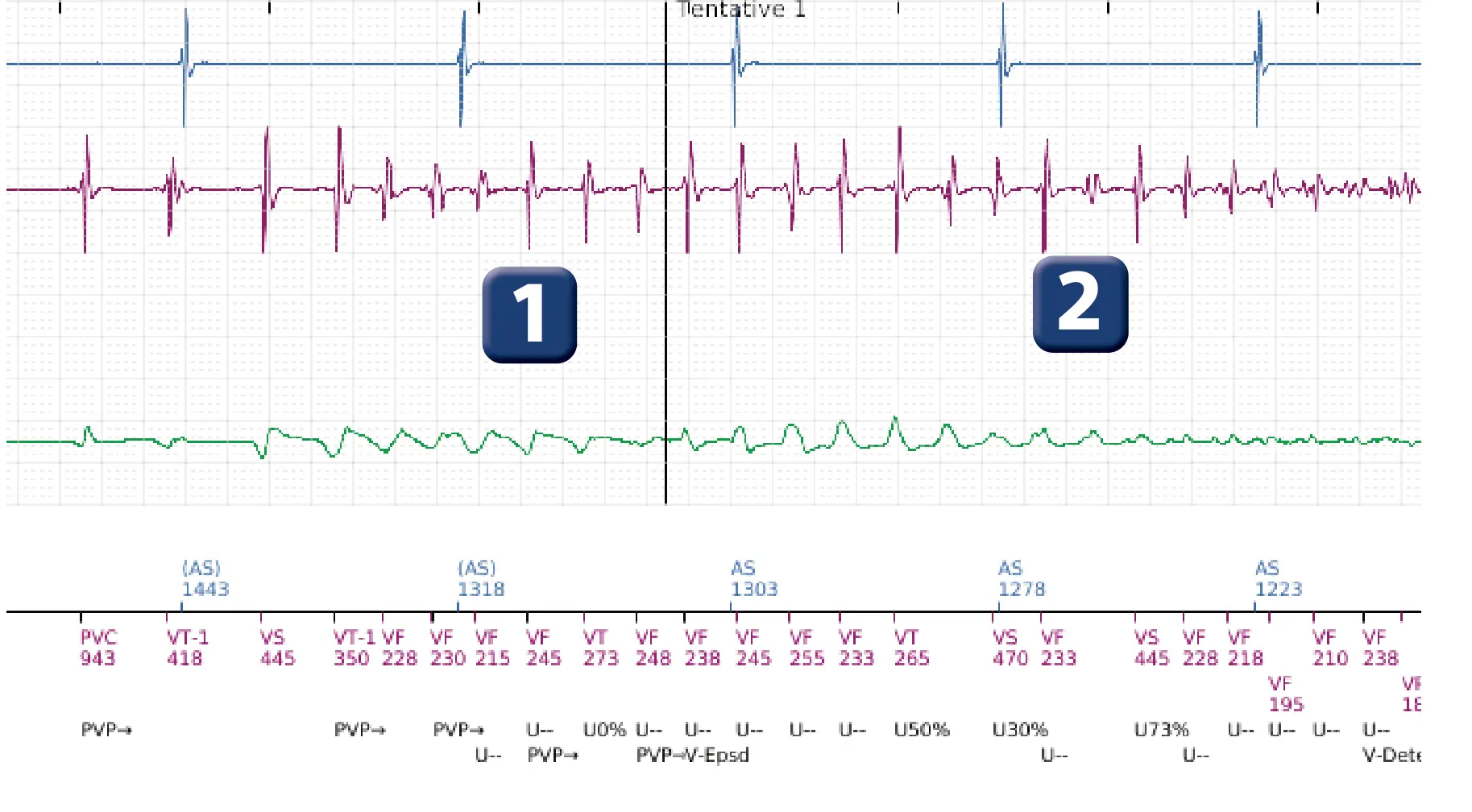 Électrogramme Boston Scientific DAI, segment 2 sur 7 — FV, choc électrique et induction de FA