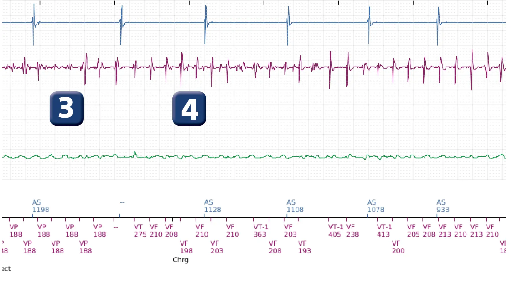 Électrogramme Boston Scientific DAI, segment 3 sur 7 — FV, choc électrique et induction de FA