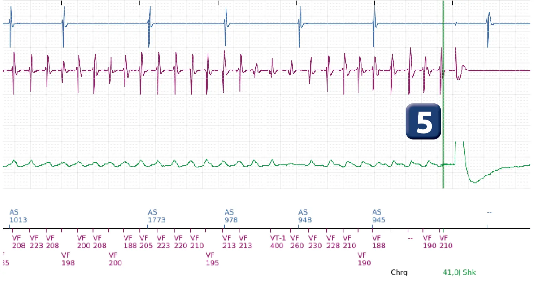 Électrogramme Boston Scientific DAI, segment 4 sur 7 — FV, choc électrique et induction de FA