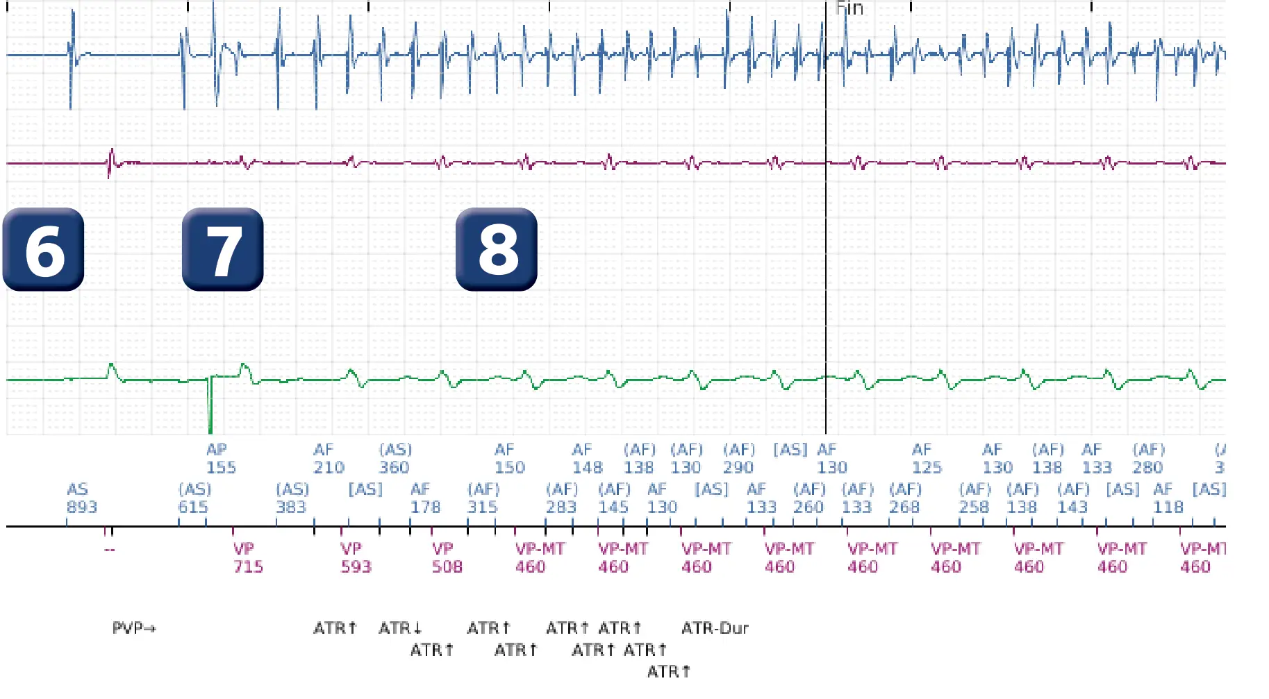 Électrogramme Boston Scientific DAI, segment 5 sur 7 — FV, choc électrique et induction de FA