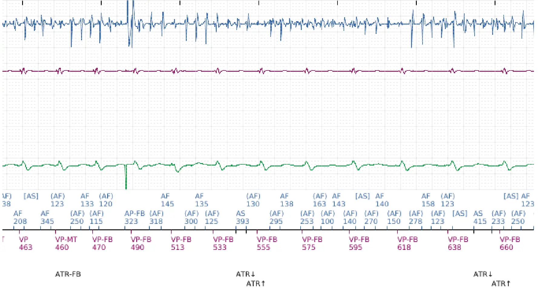 Électrogramme Boston Scientific DAI, segment 6 sur 7 — FV, choc électrique et induction de FA