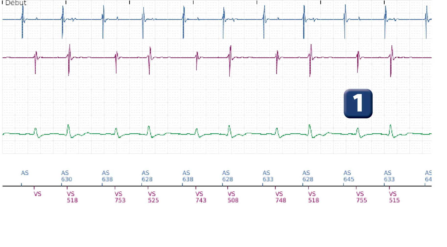 Électrogramme Boston Scientific DAI, segment 1 sur 12 — Salve d’ATP en zone de FV