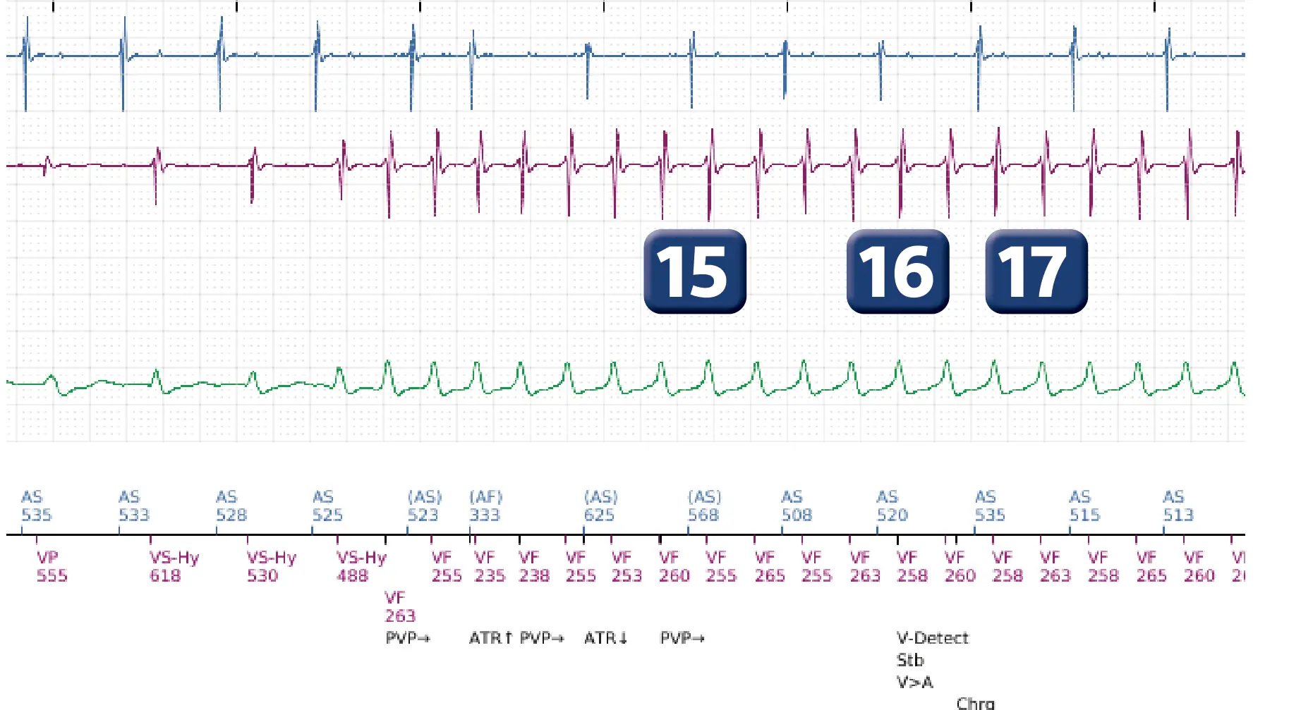 Électrogramme Boston Scientific DAI, segment 10 sur 12 — Salve d’ATP en zone de FV
