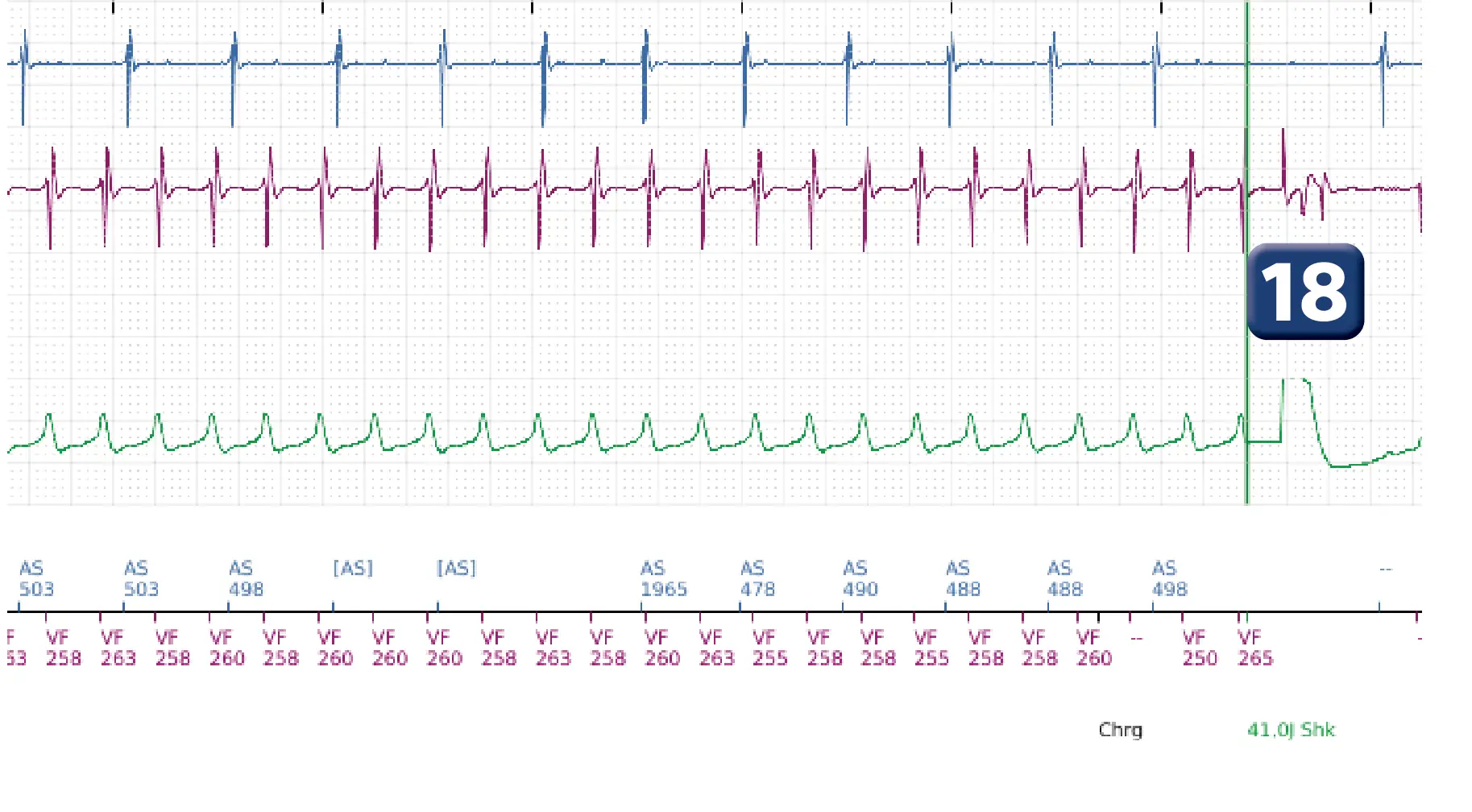 Électrogramme Boston Scientific DAI, segment 11 sur 12 — Salve d’ATP en zone de FV