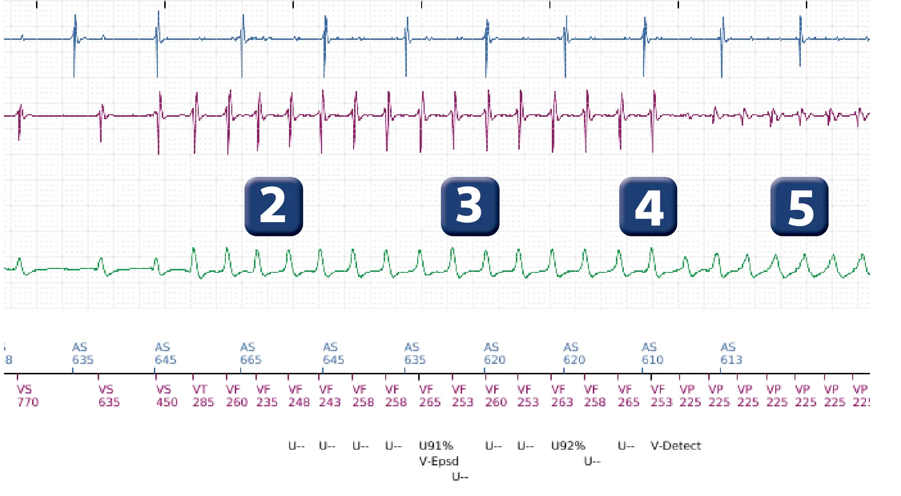 Électrogramme Boston Scientific DAI, segment 2 sur 12 — Salve d’ATP en zone de FV
