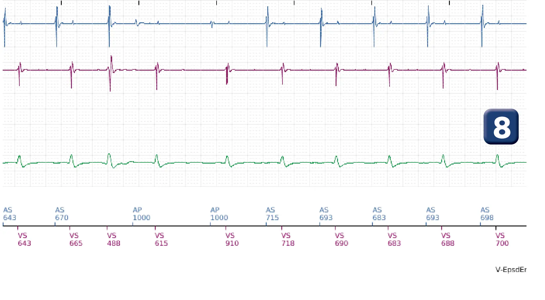 Électrogramme Boston Scientific DAI, segment 4 sur 12 — Salve d’ATP en zone de FV