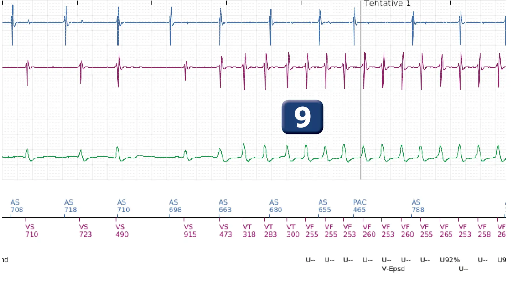 Électrogramme Boston Scientific DAI, segment 5 sur 12 — Salve d’ATP en zone de FV