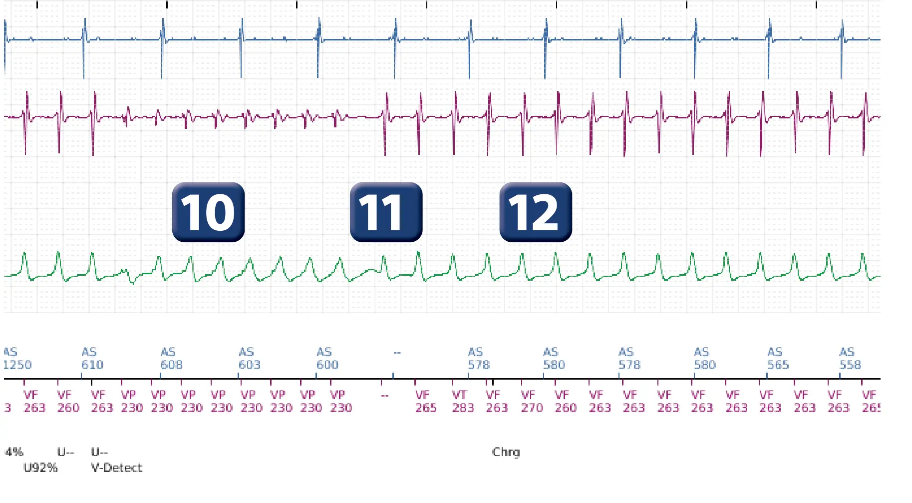 Électrogramme Boston Scientific DAI, segment 6 sur 12 — Salve d’ATP en zone de FV