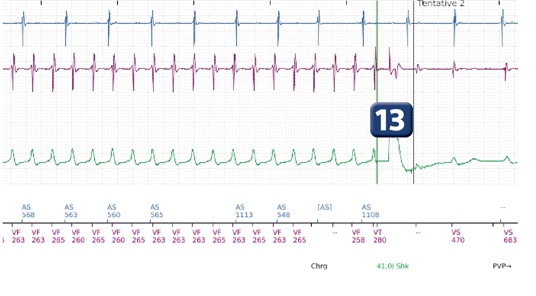 Électrogramme Boston Scientific DAI, segment 7 sur 12 — Salve d’ATP en zone de FV