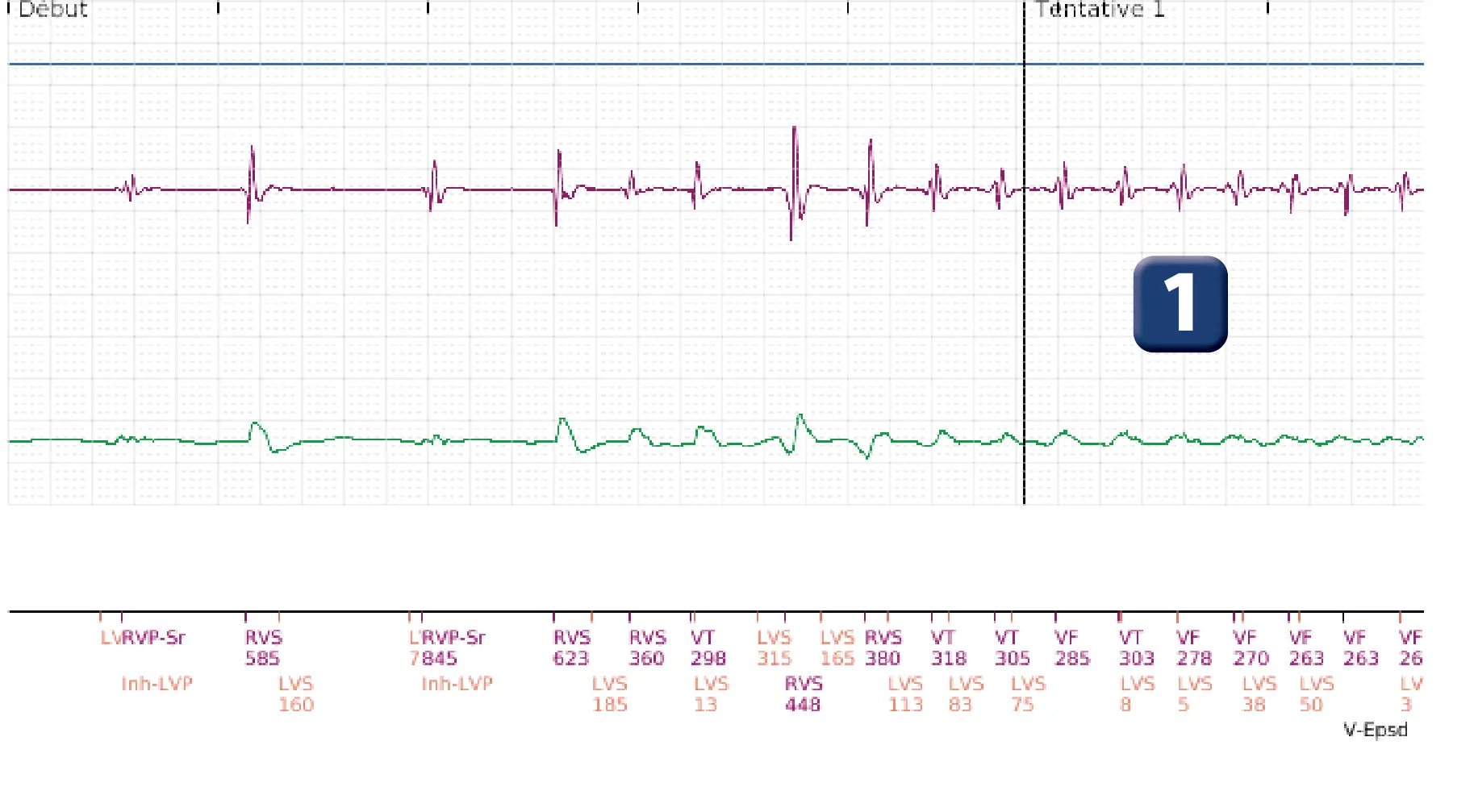 Électrogramme Boston Scientific DAI, segment 1 sur 4 — Salve d’ATP en zone de FV et accélération