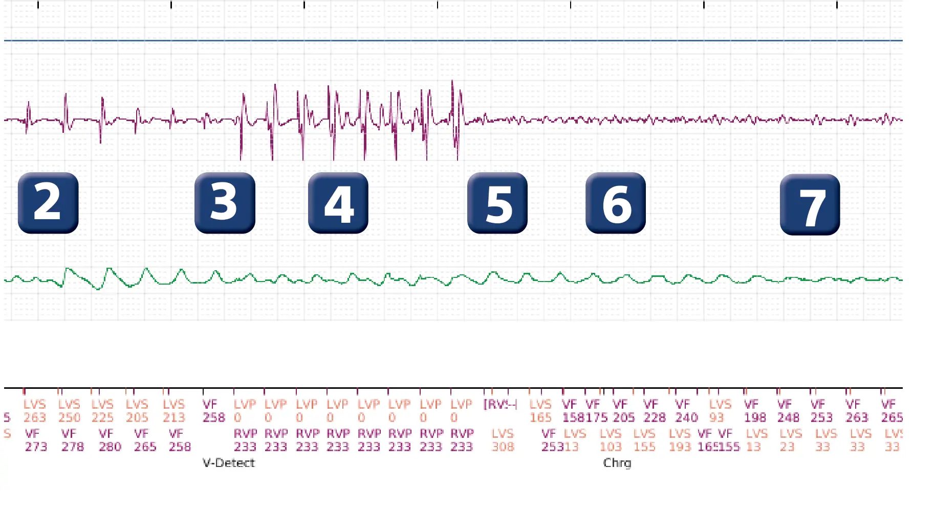 Électrogramme Boston Scientific DAI, segment 2 sur 4 — Salve d’ATP en zone de FV et accélération