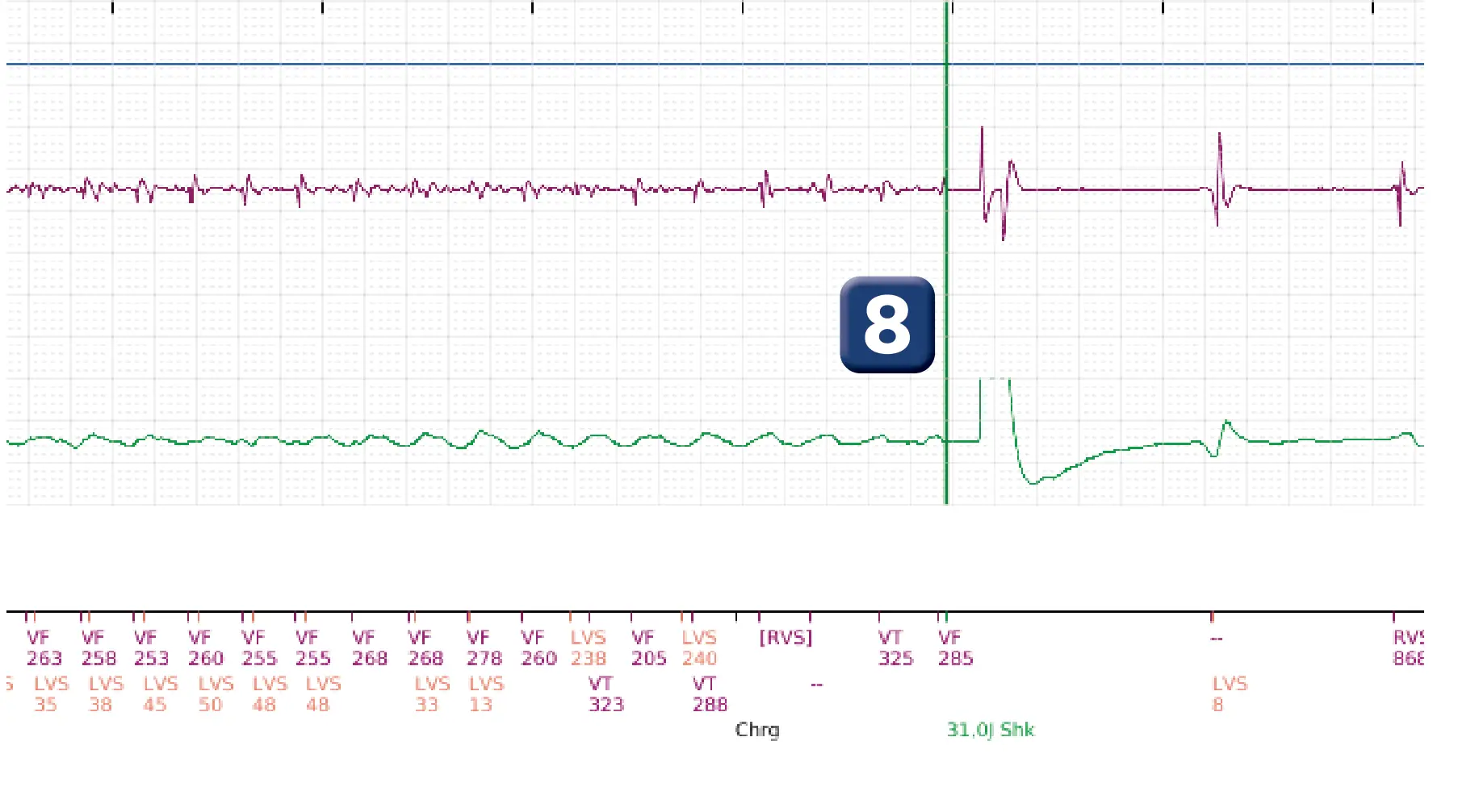 Électrogramme Boston Scientific DAI, segment 3 sur 4 — Salve d’ATP en zone de FV et accélération