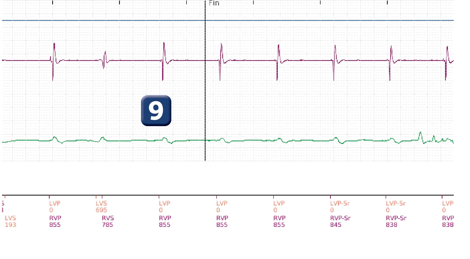 Électrogramme Boston Scientific DAI, segment 4 sur 4 — Salve d’ATP en zone de FV et accélération