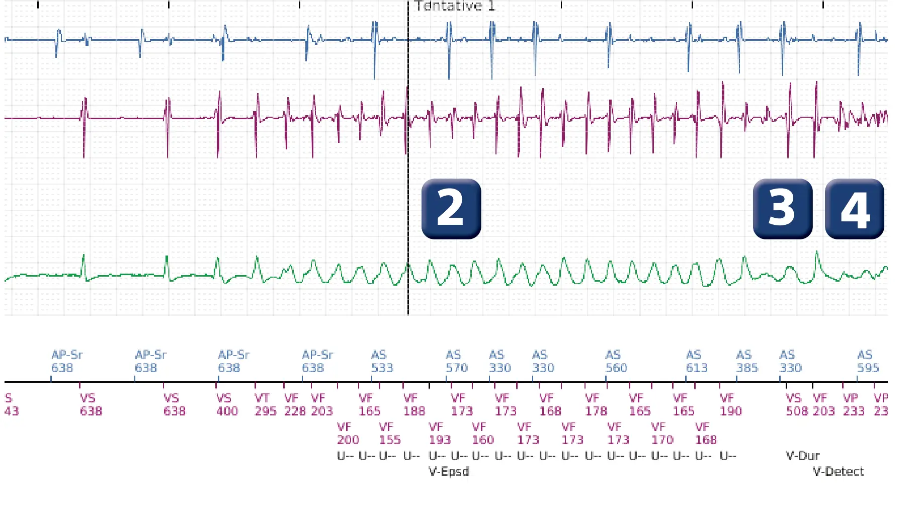 Électrogramme Boston Scientific DAI, segment 2 sur 5 — Sous-détection, erreur de calcul de la fréquence et salve d’ATP en zone de FV