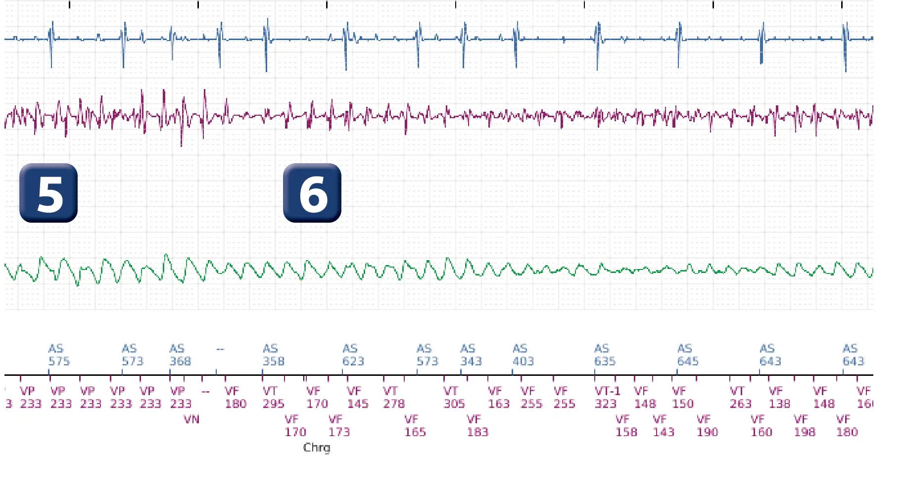 Électrogramme Boston Scientific DAI, segment 3 sur 5 — Sous-détection, erreur de calcul de la fréquence et salve d’ATP en zone de FV
