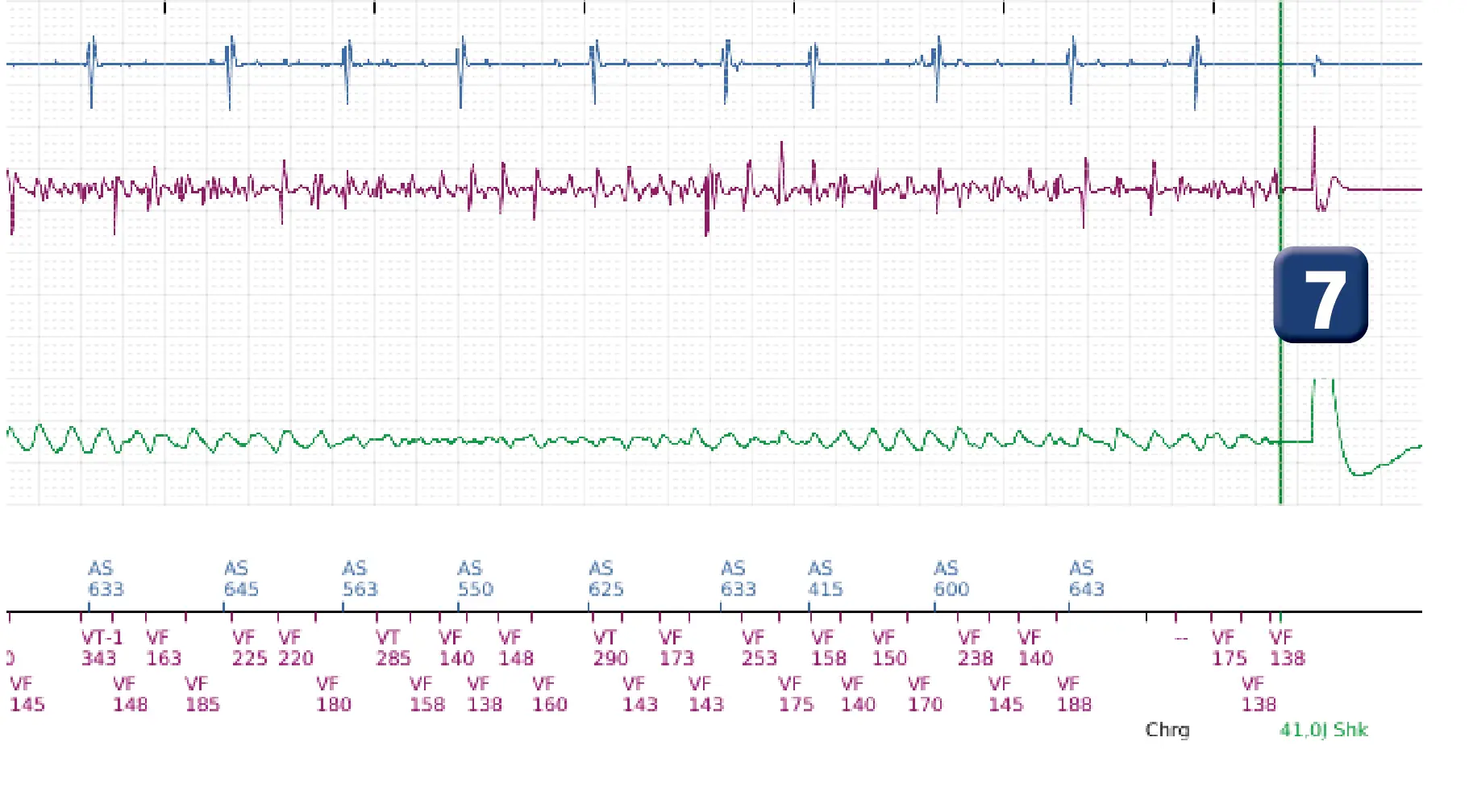 Électrogramme Boston Scientific DAI, segment 4 sur 5 — Sous-détection, erreur de calcul de la fréquence et salve d’ATP en zone de FV
