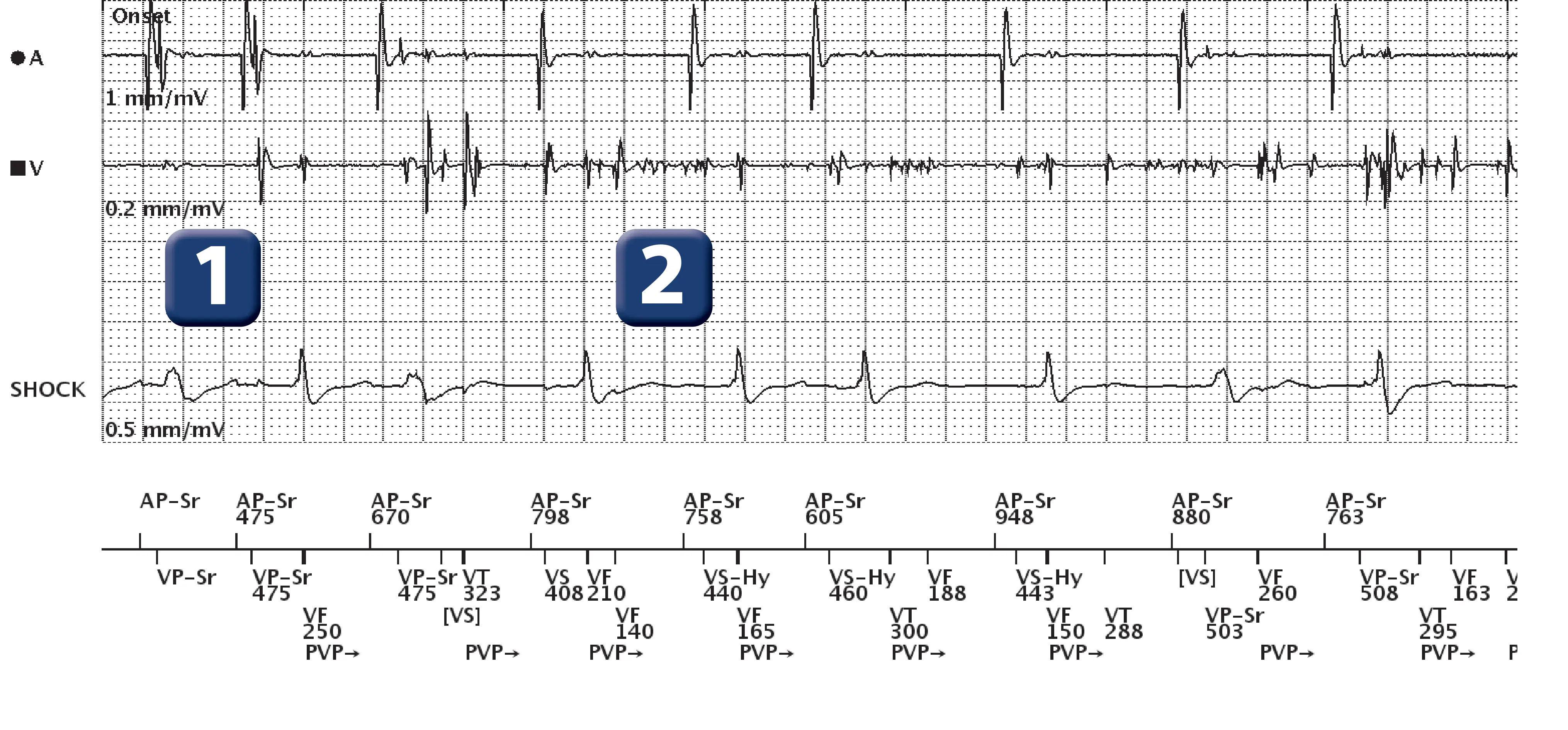 Électrogramme Boston Scientific DAI, segment 1 sur 7 — Surdétection et stimulation anti-tachycardique en zone de FV