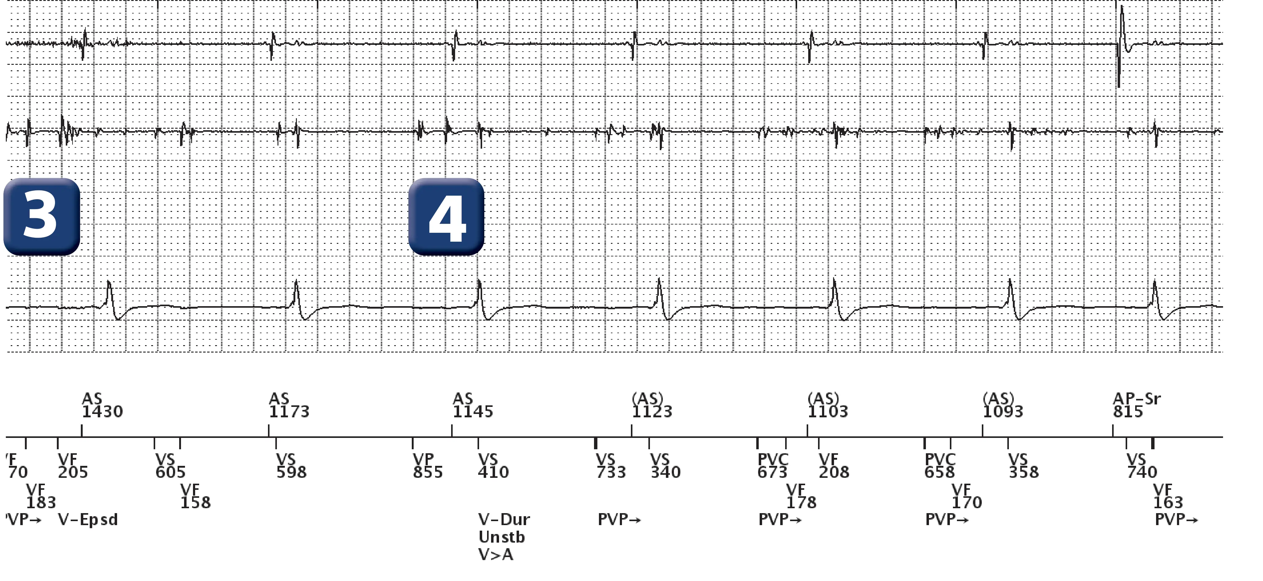 Électrogramme Boston Scientific DAI, segment 2 sur 7 — Surdétection et stimulation anti-tachycardique en zone de FV