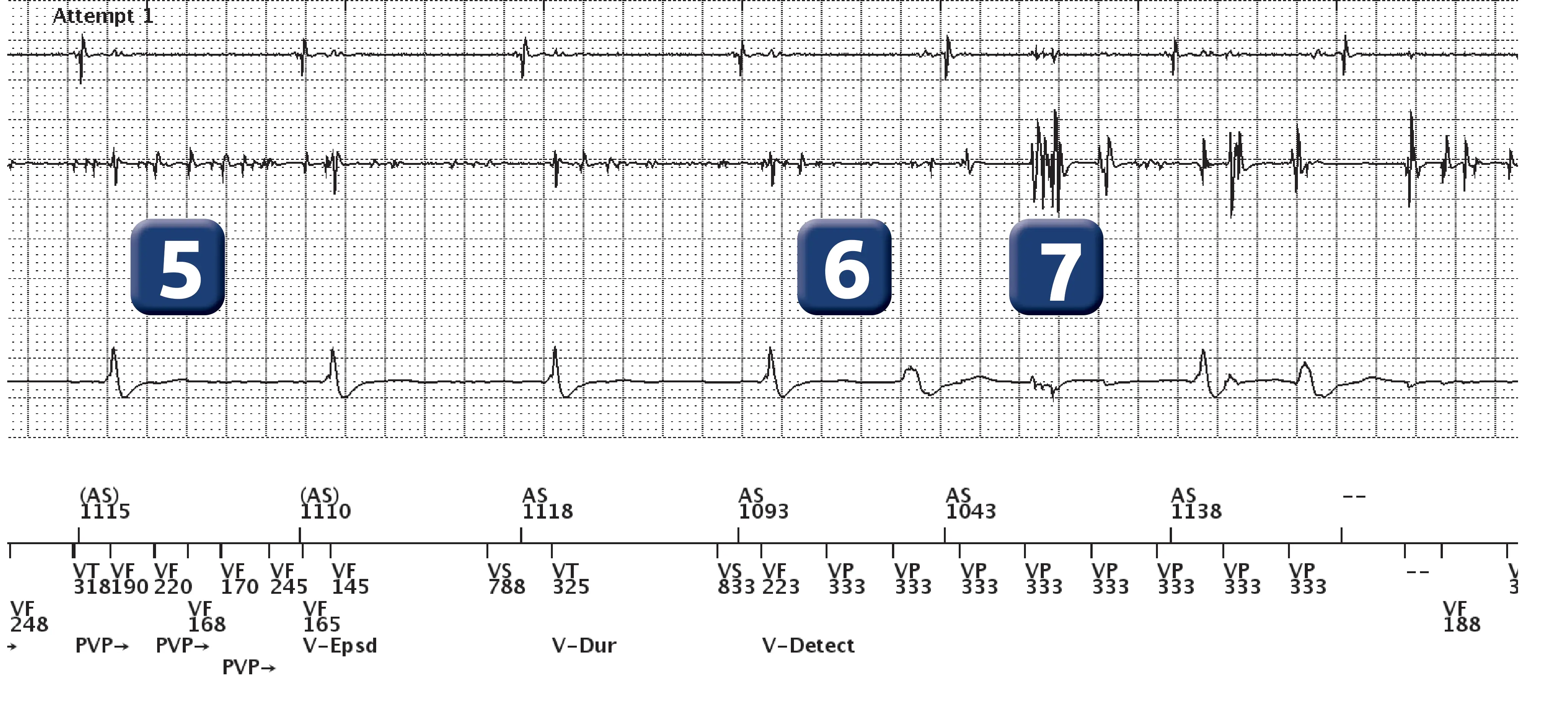 Électrogramme Boston Scientific DAI, segment 4 sur 7 — Surdétection et stimulation anti-tachycardique en zone de FV