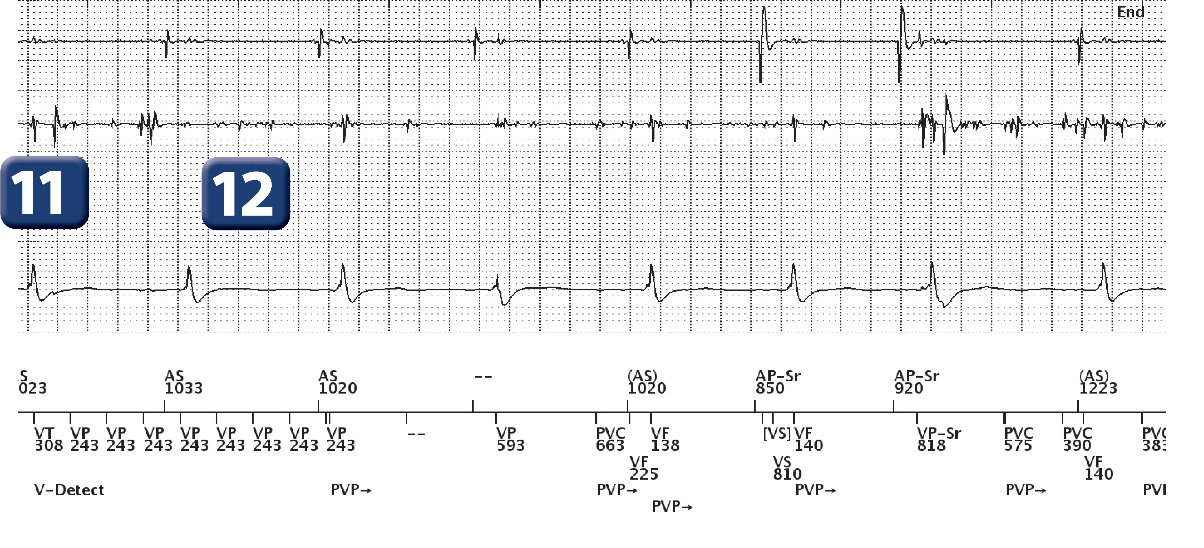 Électrogramme Boston Scientific DAI, segment 6 sur 7 — Surdétection et stimulation anti-tachycardique en zone de FV