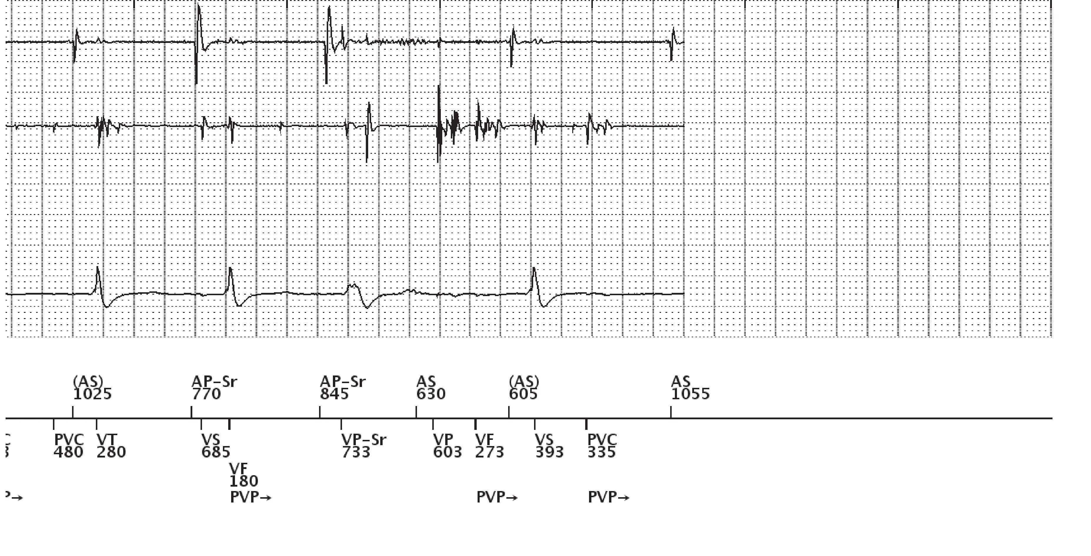 Électrogramme Boston Scientific DAI, segment 7 sur 7 — Surdétection et stimulation anti-tachycardique en zone de FV