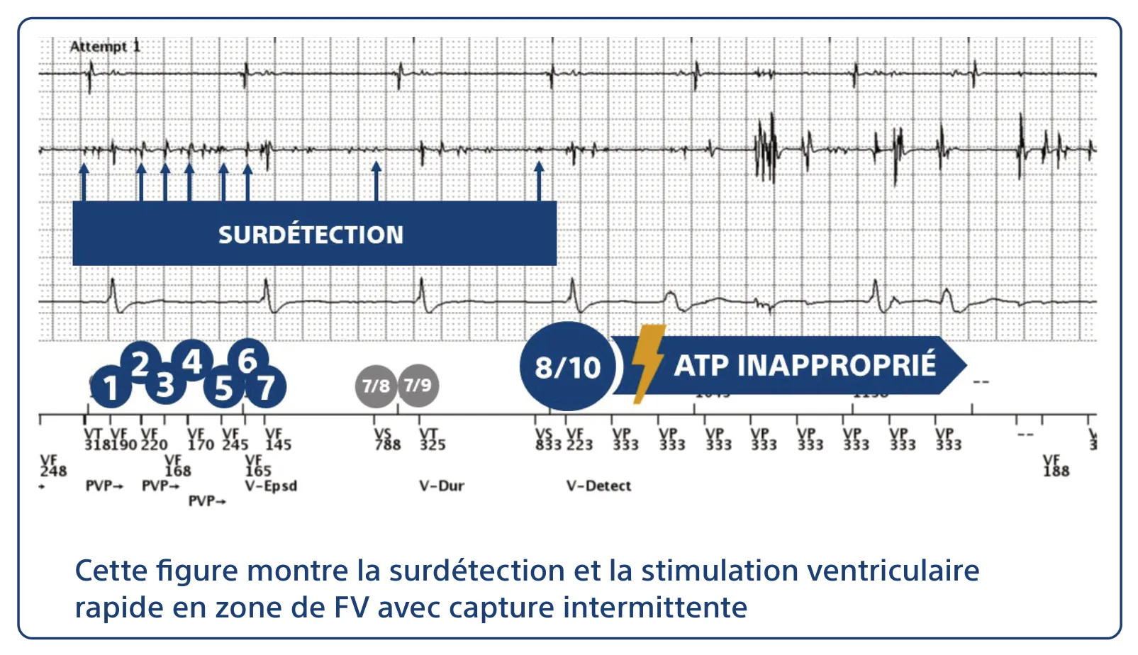 Cette figure montre la surdétection et la stimulation ventriculaire rapide en zone de FV avec capture intermittente