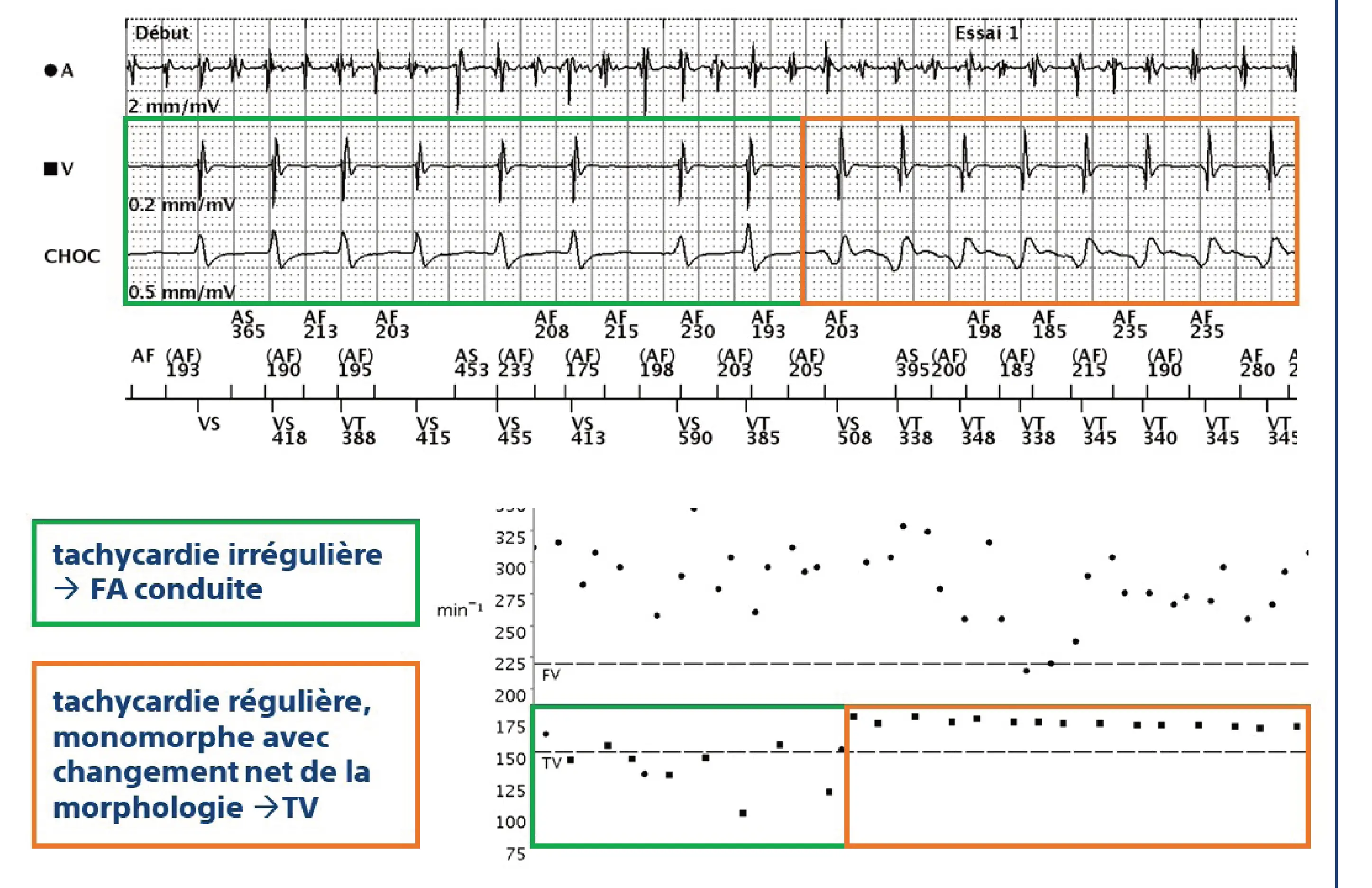 Électrogramme Boston Scientific DAI, segment 6 sur 6 — Discrimination double chambre et bi-tachycardie