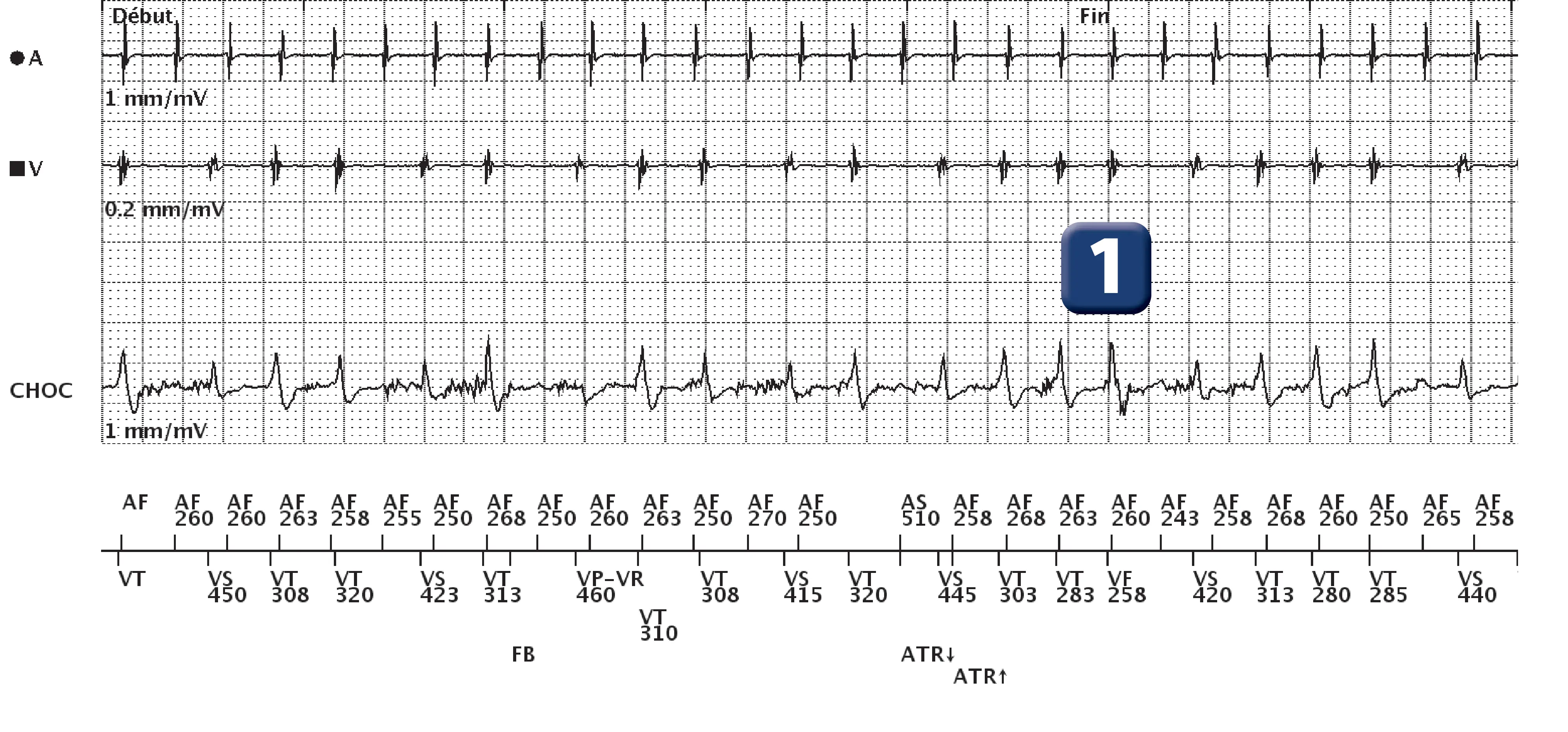 Électrogramme Boston Scientific DAI, segment 1 sur 3 — Discrimination double chambre et FA conduite avec aberration de conduction