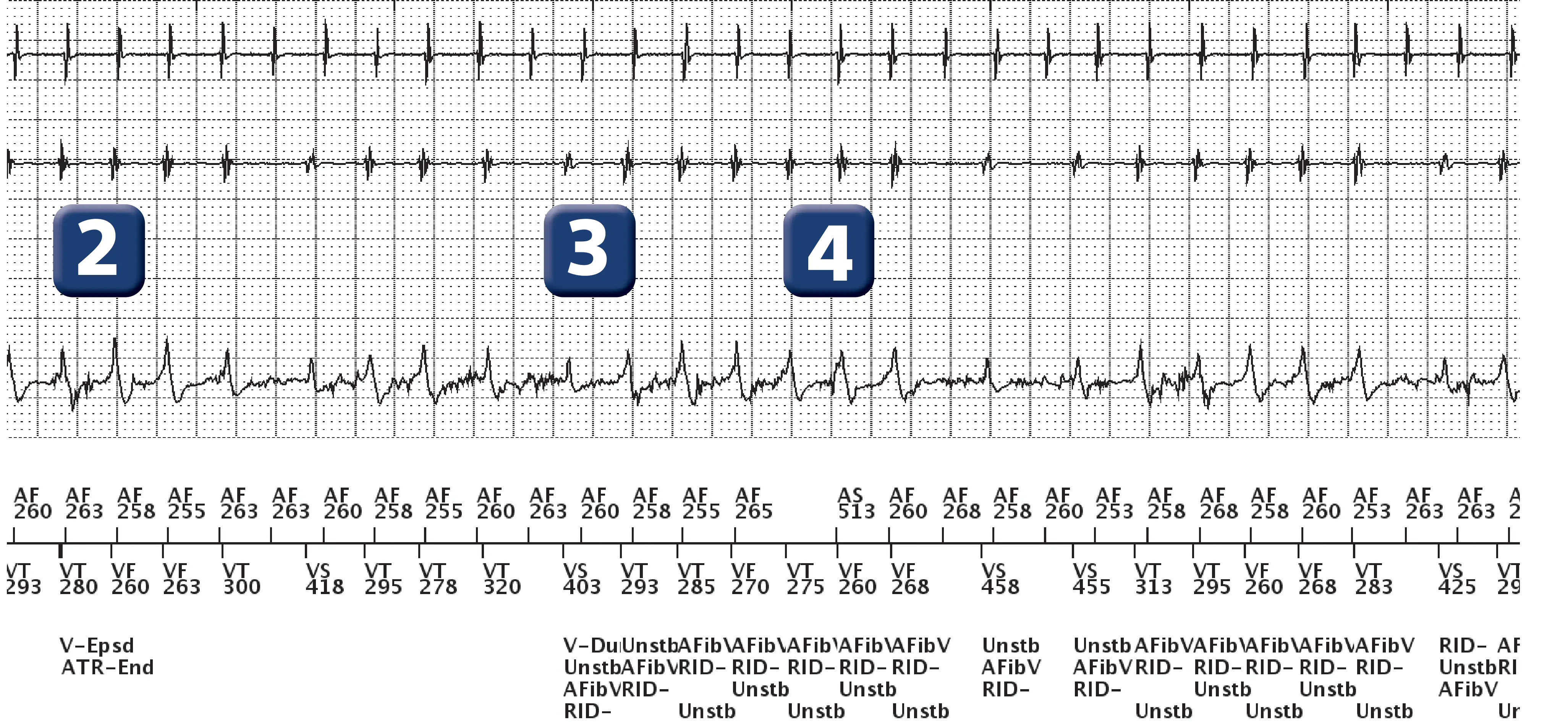 Électrogramme Boston Scientific DAI, segment 2 sur 3 — Discrimination double chambre et FA conduite avec aberration de conduction