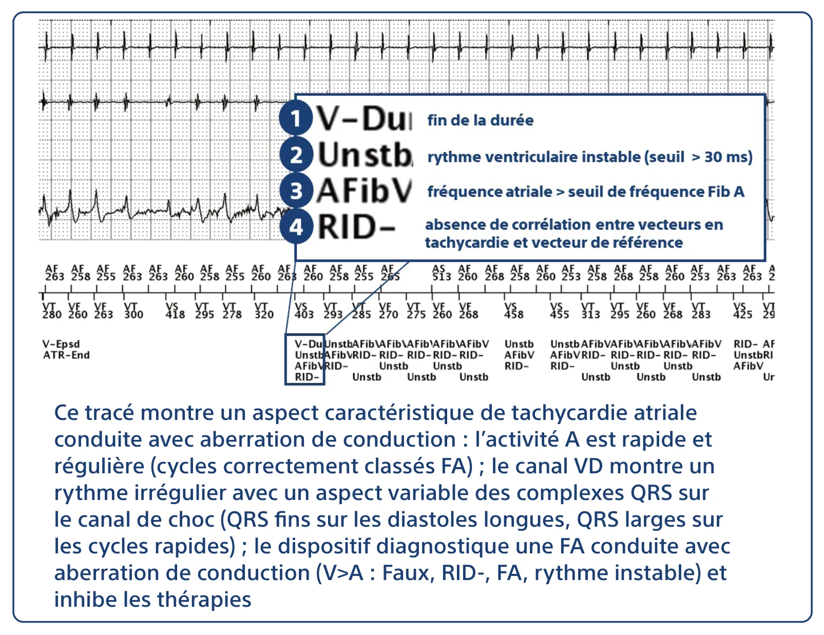 Ce tracé montre un aspect caractéristique de tachycardie atriale conduite avec aberration de conduction : l’activité A est rapide et régulière (cycles correctement classés FA) ; le canal VD montre un rythme irrégulier avec un aspect variable des complexes QRS sur le canal de choc (QRS fins sur les diastoles longues, QRS larges sur les cycles rapides) ; le dispositif diagnostique une FA conduite avec aberration de conduction (V>A : Faux, RID-, FA, rythme instable) et inhibe les thérapies