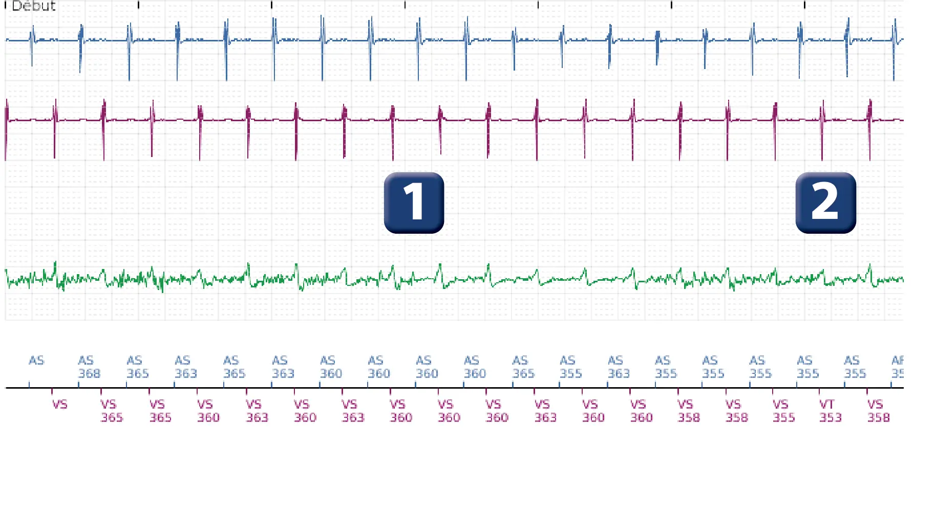 Électrogramme Boston Scientific DAI, segment 1 sur 10 — Discrimination double chambre et erreur de discrimination par altération du signal du canal de choc