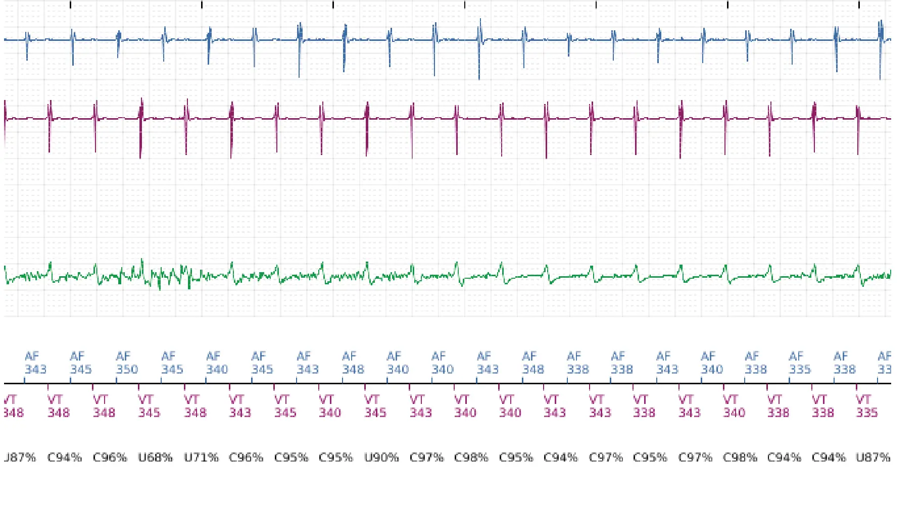 Électrogramme Boston Scientific DAI, segment 3 sur 10 — Discrimination double chambre et erreur de discrimination par altération du signal du canal de choc
