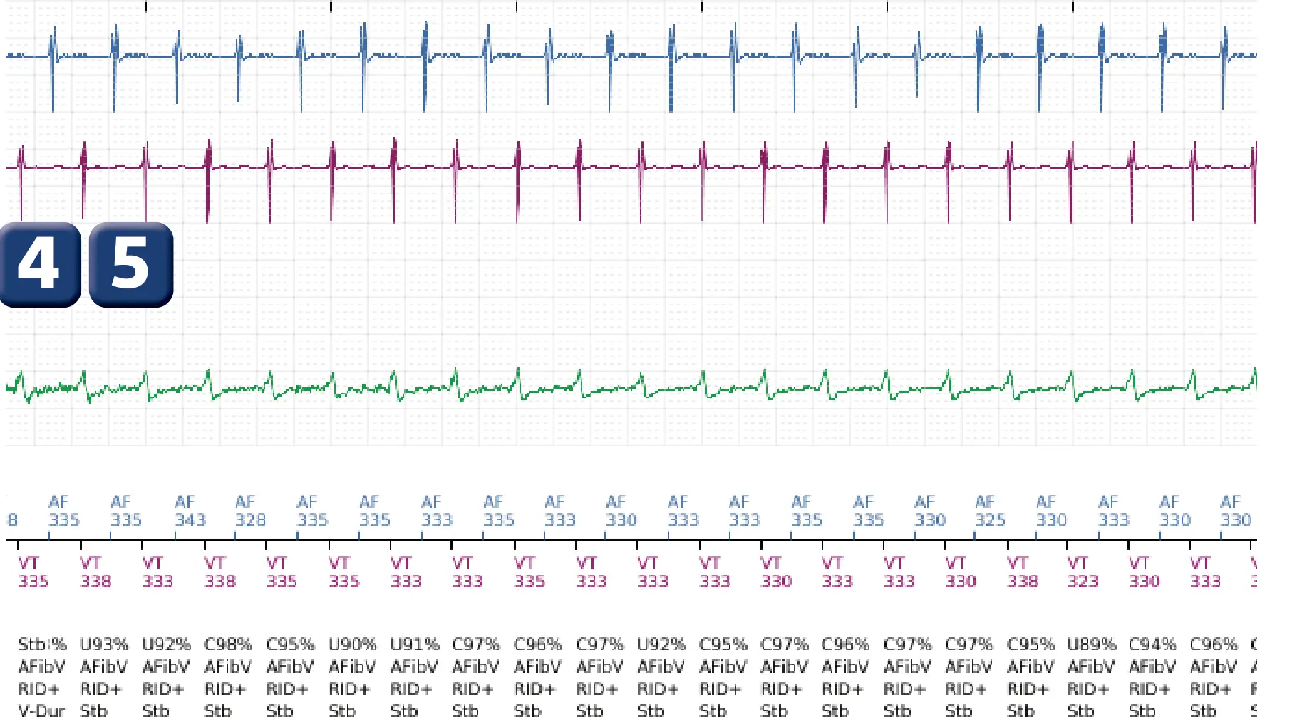 Électrogramme Boston Scientific DAI, segment 4 sur 10 — Discrimination double chambre et erreur de discrimination par altération du signal du canal de choc