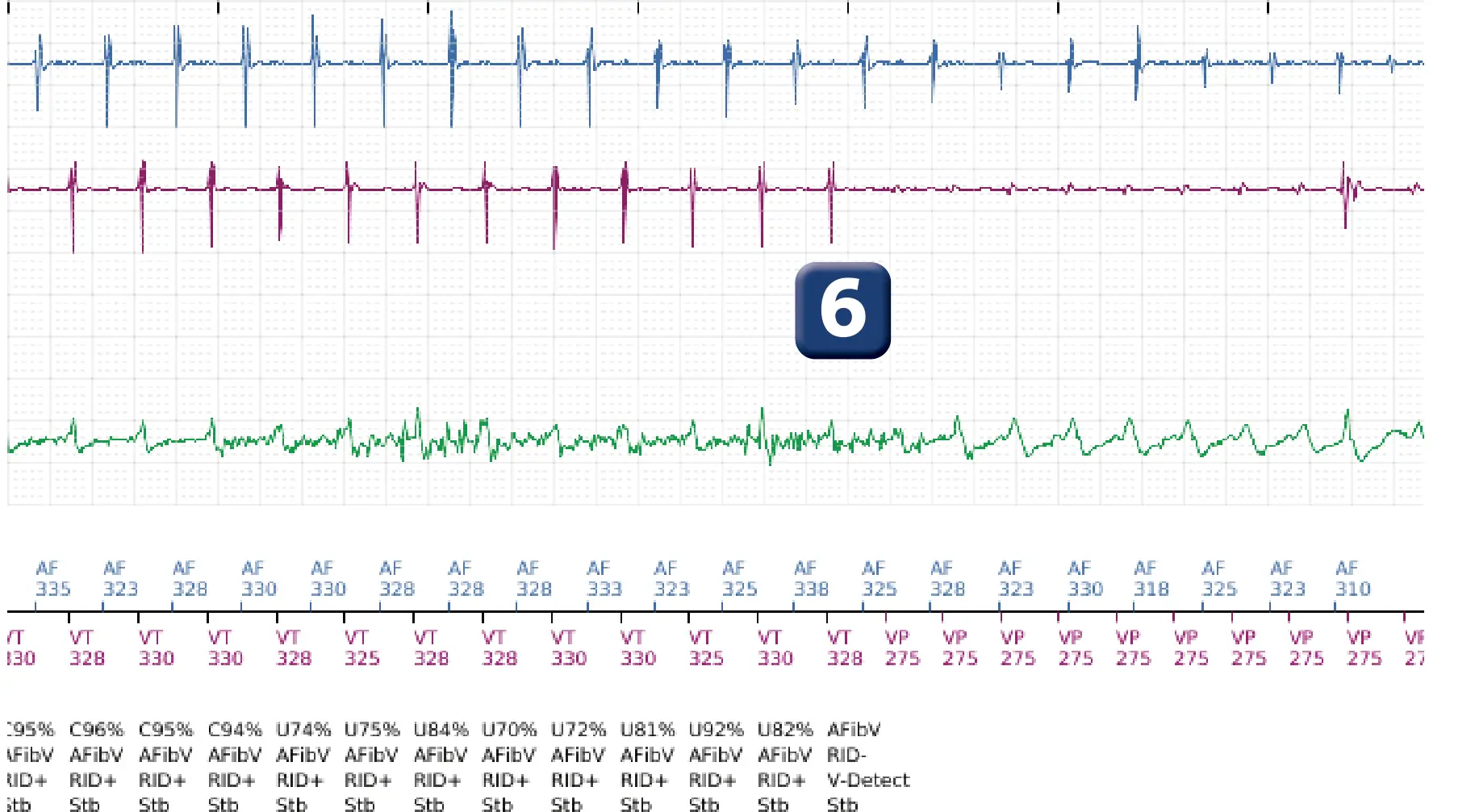 Électrogramme Boston Scientific DAI, segment 5 sur 10 — Discrimination double chambre et erreur de discrimination par altération du signal du canal de choc