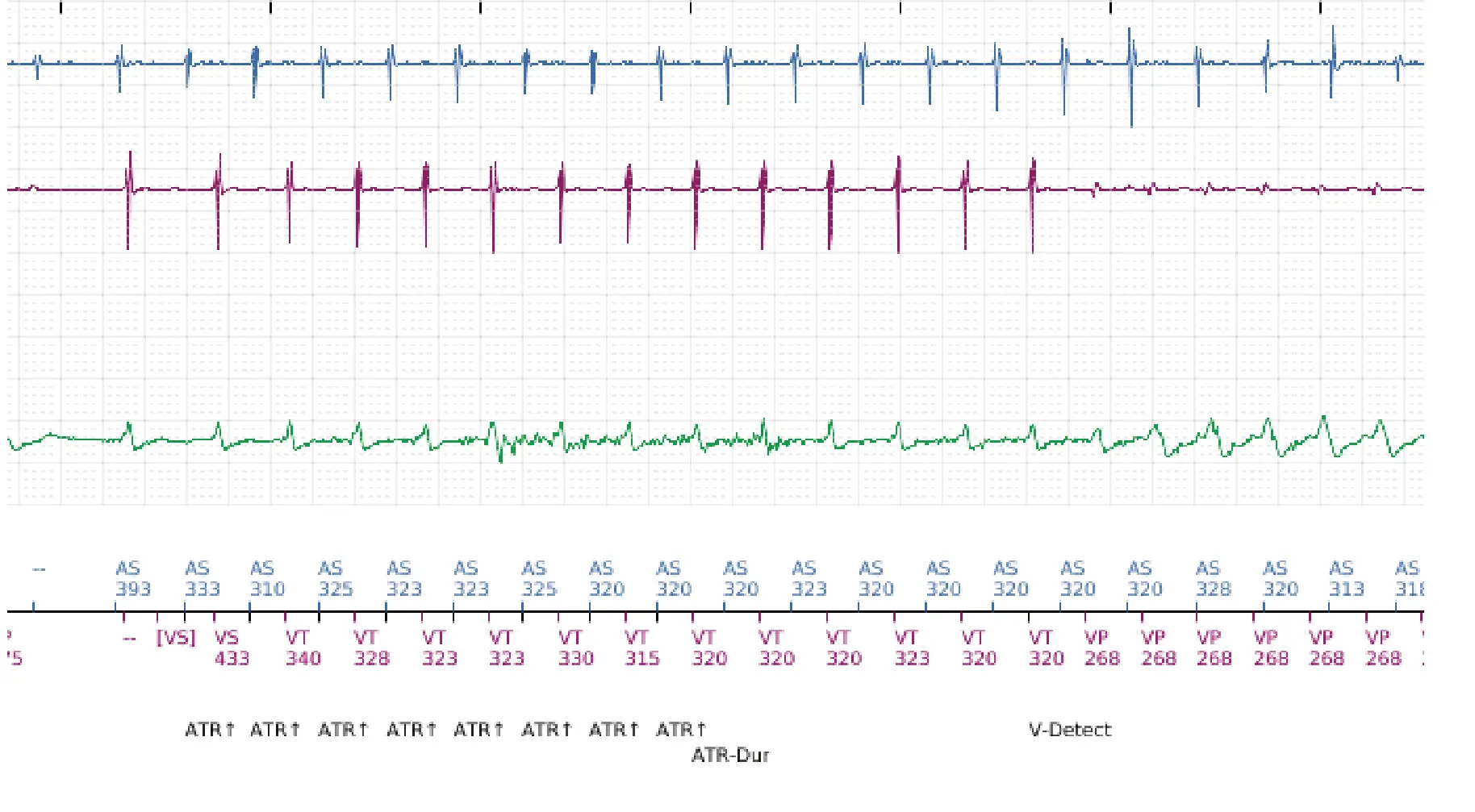 Électrogramme Boston Scientific DAI, segment 6 sur 10 — Discrimination double chambre et erreur de discrimination par altération du signal du canal de choc